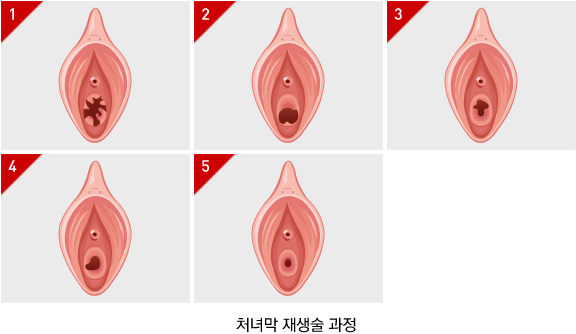 처녀막재생술