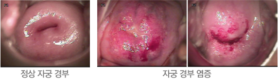 자궁경부염