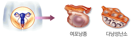 다낭성 난소증후군 이미지