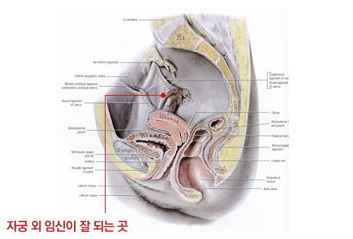 자궁외임신 잘되는 곳