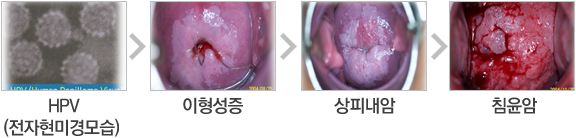 HPV, 이형성증, 상피내암, 침윤암 사진